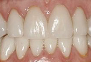 The image shows a close-up view of a person s teeth with a focus on the front lower teeth, which appear to be a bridge or dental implant.