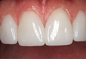 The image shows a close-up view of a person s teeth with a focus on dental veneers, highlighting their bright white color and glossy finish.