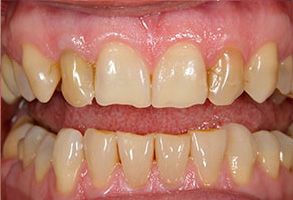 The image shows two photographs of a person s teeth with an open mouth, revealing decayed and discolored teeth, which appear to be in poor condition.
