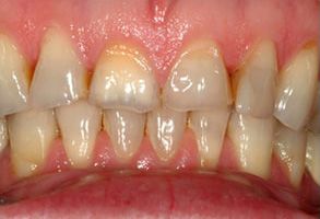 The image shows a close-up view of a person s teeth with significant discoloration and decay, which appears to be a before and after comparison of dental treatment, likely showcasing the results of teeth whitening or dental restoration.